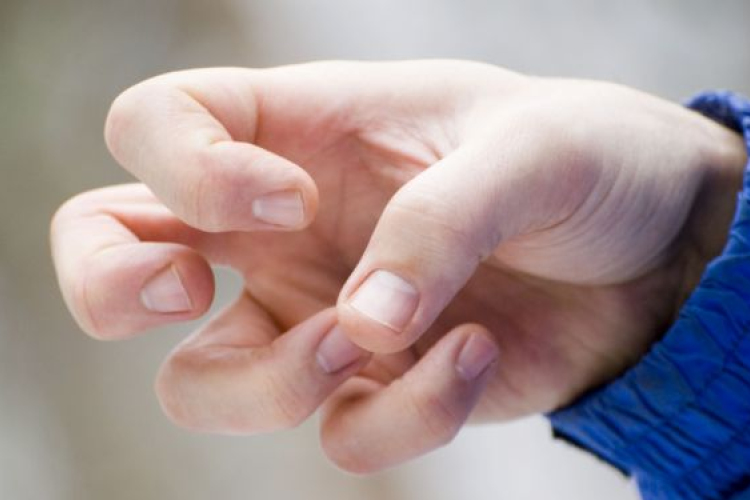 Genetikai okokra vezethető vissza az epilepszia
